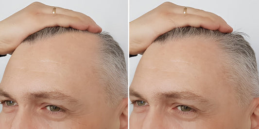 Unlock the Power of Minoxidil: A Guide to Enhanced Hair Regrowth